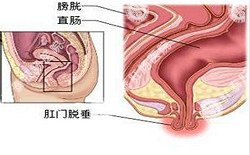 南寧治療脫肛哪家醫(yī)院好？南寧脫肛治療多少錢？